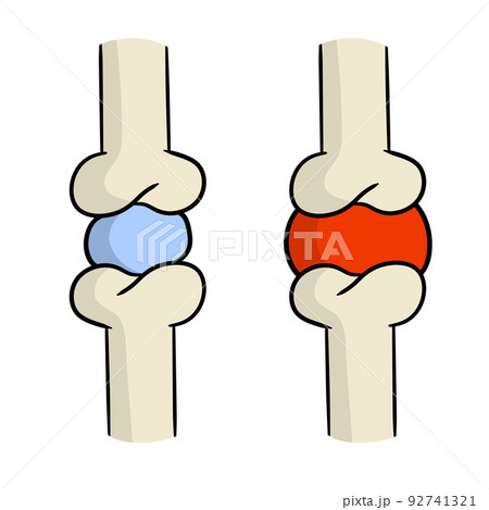 Arthritis. Disease of joints Arthritis. Disease of joints 92741321