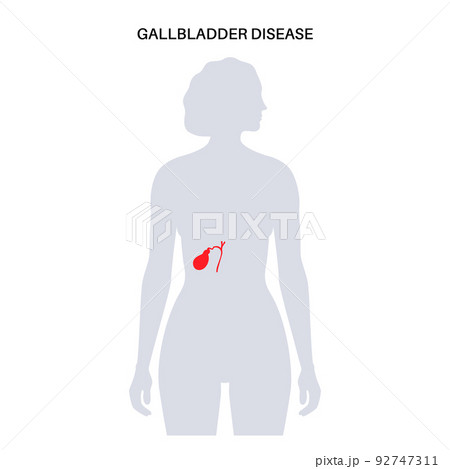 gallbladder disease poster 92747311