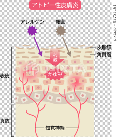 Mechanism of atopic dermatitis Skin cells and cross section 92753161