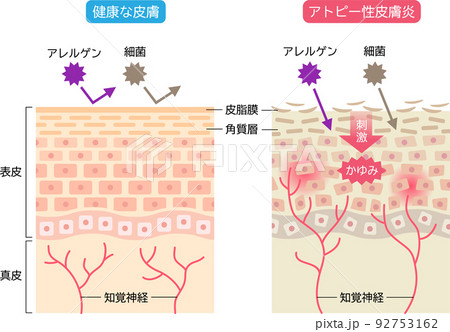 アトピー性皮膚炎と健康な皮膚　比べる　肌細胞と断面図 92753162