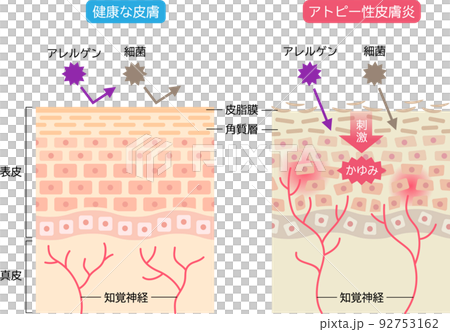特應性皮炎和健康皮膚比較皮膚細胞和橫截面 92753162