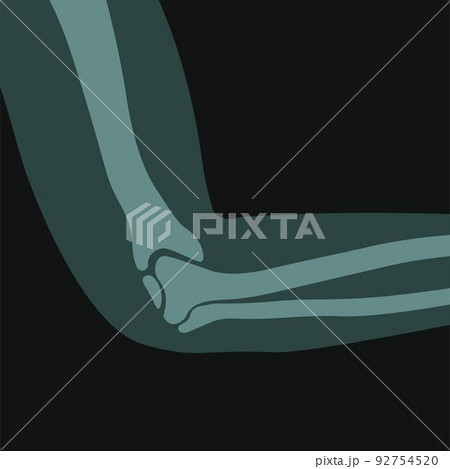 X ray of human elbow, screen or scan in clinics X ray of human elbow, screen or scan in clinics 92754520