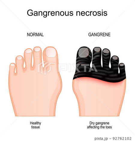 Gangrene affecting the toes.. tissue death by Gangrenous necrosis 92762102