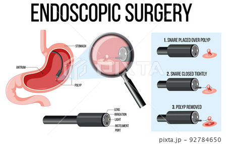 Diagram showing endoscopic surgery Diagram showing endoscopic surgery 92784650