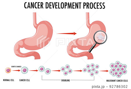 Diagram showing normal and cancer cells in human Diagram showing normal and cancer cells in human 92786302