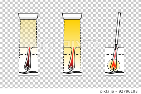 Image of hair removal, esthetic hair removal, medical laser hair removal, needle hair removal Image of hair removal, esthetic hair removal, medical laser hair removal, needle hair removal 92796198