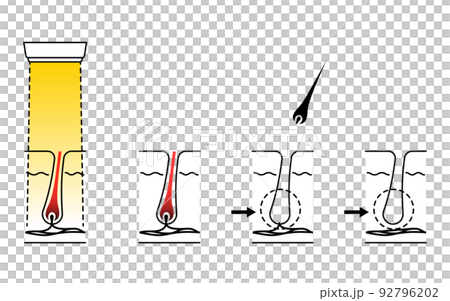 Image of hair removal, flow of hair loss after medical laser hair removal treatment 92796202