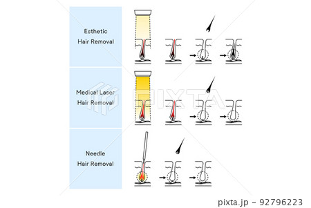 脱毛のイメージ、エステ脱毛・医療用レーザー脱毛・ニードル脱毛 92796223