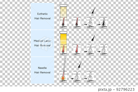 脱毛のイメージ、エステ脱毛・医療用レーザー脱毛・ニードル脱毛 92796223