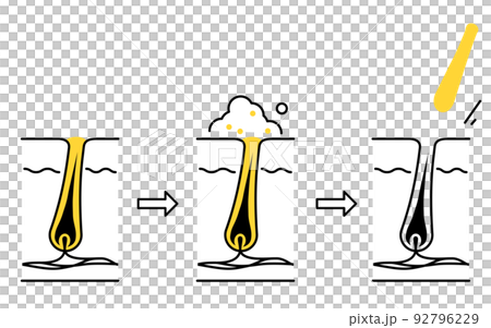 Illustration of skin care, image of cleaning pores and removing keratin plugs Illustration of skin care, image of cleaning pores and removing keratin plugs 92796229