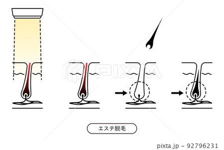 脱毛のイメージ、エステ脱毛を施術してから毛が抜ける流れ 脱毛のイメージ、エステ脱毛を施術してから毛が抜ける流れ 92796231