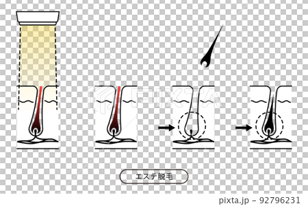 脱毛のイメージ、エステ脱毛を施術してから毛が抜ける流れ 脱毛のイメージ、エステ脱毛を施術してから毛が抜ける流れ 92796231