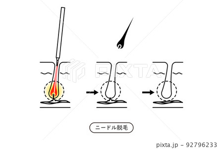 脱毛のイメージ、ニードル脱毛を施術してから毛が抜ける流れ 脱毛のイメージ、ニードル脱毛を施術してから毛が抜ける流れ 92796233
