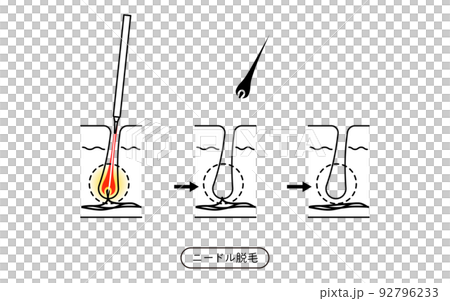 脱毛のイメージ、ニードル脱毛を施術してから毛が抜ける流れ 脱毛のイメージ、ニードル脱毛を施術してから毛が抜ける流れ 92796233