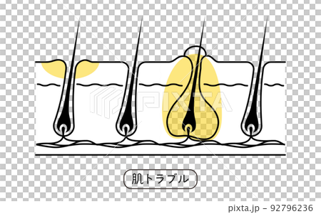 脱毛のイメージ、肌トラブル、毛を自分で剃って肌が荒れた状態 92796236