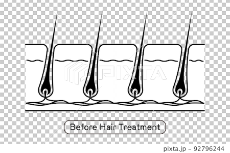 Image of hair removal, before and after hair treatment 92796244