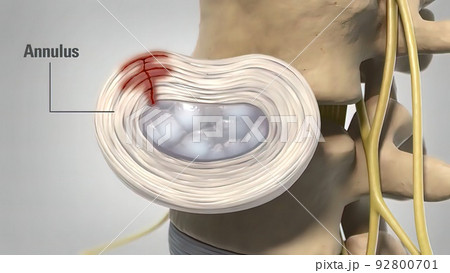 Degenerative dics disease 3d medical Degenerative dics disease 3d medical 92800701