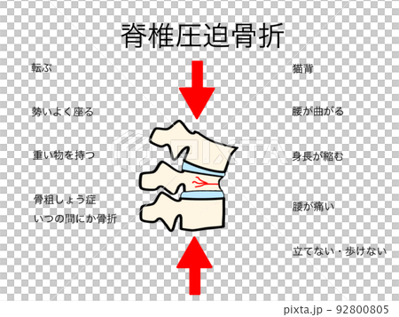 脊椎圧迫骨折のイラスト 92800805