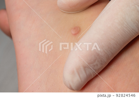 A doctor examines a wart on a child's body. 92824546