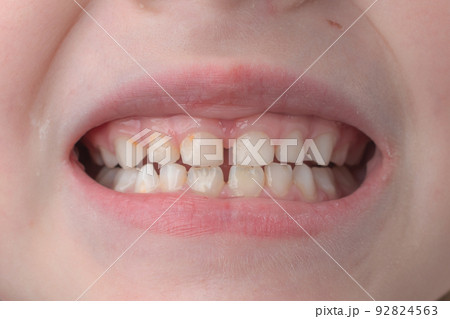 Jaw with children's straight teeth close-up. 92824563