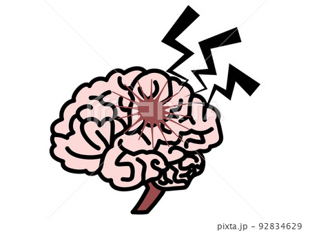 brain with cerebral infarction - Stock Illustration [92834629] - PIXTA