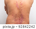 Psoriasis is that back on white background. 92842242