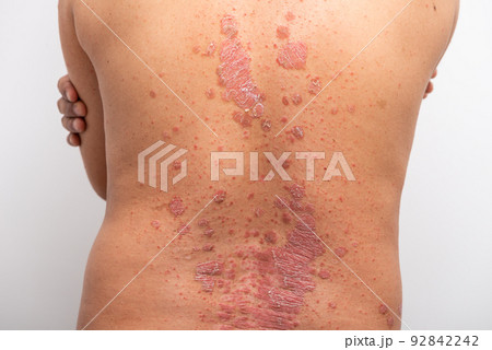 Psoriasis is that back on white background. 92842242