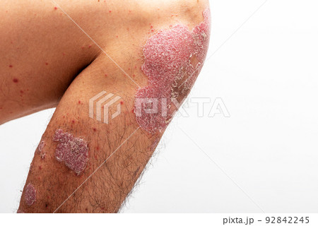 Psoriasis is that knee on white background. 92842245