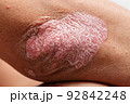 CU Shot, Psoriasis is that elbow on white background. 92842248