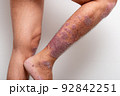 Psoriasis is that knee on white background. 92842251