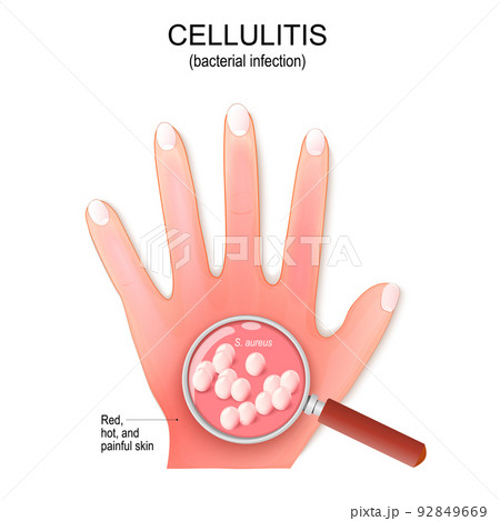 Cellulitis. Humans hand with bacterial infection. 92849669