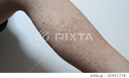 アレルギー反応が出たふくらはぎの写真 アレルギー反応が出たふくらはぎの写真 92851778