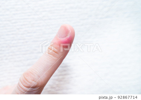 ひょう疽の写真。膿が出ている写真。 92867714