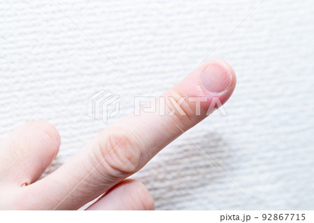 ひょう疽の写真。膿が出ている写真。 92867715