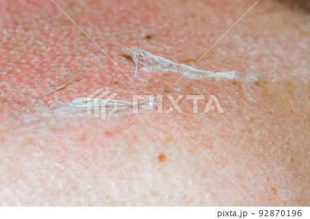Close Up on small thin transparent piece of skin after sunburn. Close Up on small thin transparent piece of skin after sunburn. 92870196