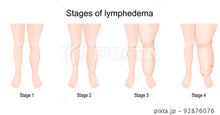 lymphedema stages. 92876076