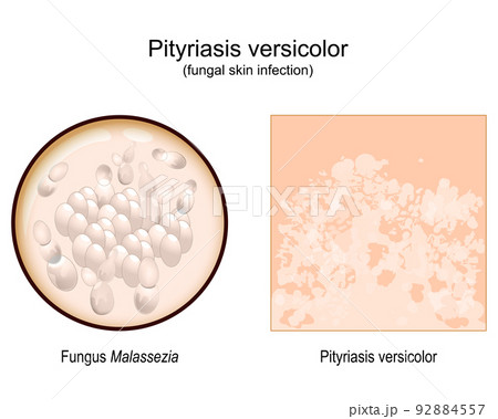 pityriasis versicolor. skin surface. Malassezia fungi 92884557