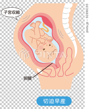切迫早産　子宮の中の赤ちゃん　妊娠中の母体の仕組み 92898193