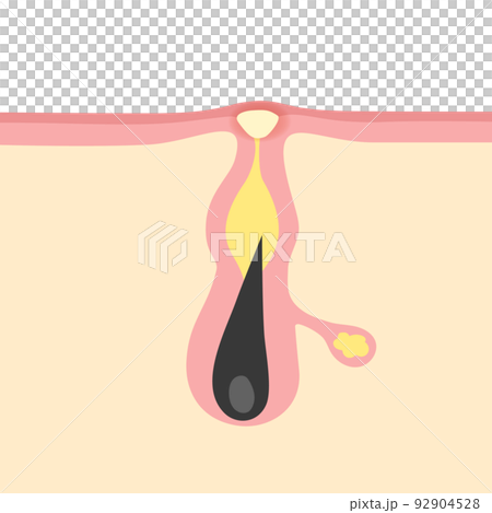 白ニキビのイメージイラスト 白ニキビのイメージイラスト 92904528