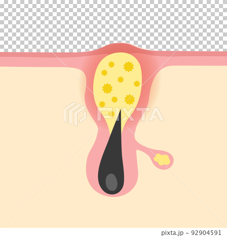 Yellow acne image illustration Yellow acne image illustration 92904591