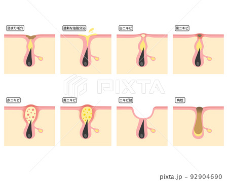 色んな肌トラブル 色んな肌トラブル 92904690