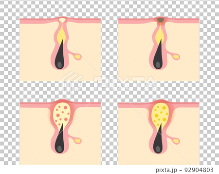 Types of acne Types of acne 92904803