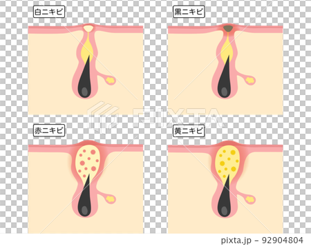 Types of acne 92904804