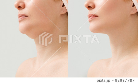 Female double chin before and after correction. Correction of the chin shape liposuction of the neck. The result of the procedure in the clinic of aesthetic medicine. Female double chin before and after correction. Correction of the chin shape liposuction of the neck. The result of the procedure in the clinic of aesthetic medicine. 92937787