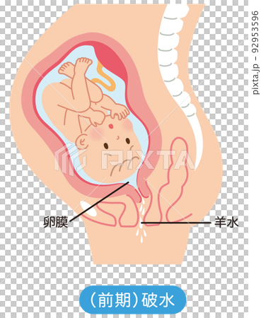 過早破水、胎中嬰兒、孕期母體機制 92953596
