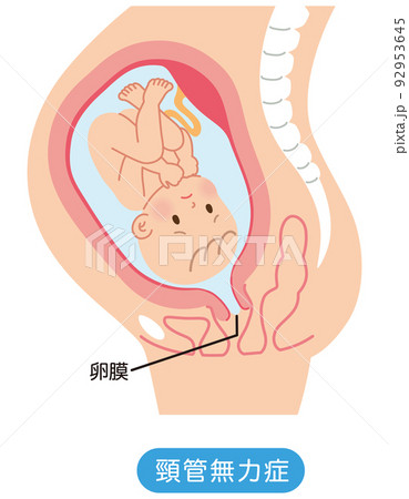 頸管無力症　子宮の中の赤ちゃん　妊娠中の母体の仕組み 92953645