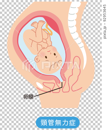 頸管無力症　子宮の中の赤ちゃん　妊娠中の母体の仕組み 92953645
