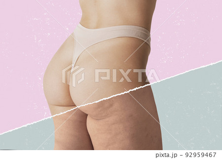 Collage. Cropped female body in underwear, buttocks and legs. Comparison of smooth and cellulite skin Collage. Cropped female body in underwear, buttocks and legs. Comparison of smooth and cellulite skin 92959467