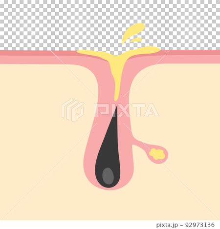 皮脂の過剰分泌のイメージイラスト 皮脂の過剰分泌のイメージイラスト 92973136