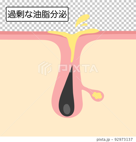 Image illustration of excessive secretion of sebum Image illustration of excessive secretion of sebum 92973137
